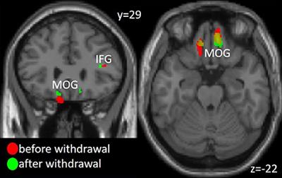 Cortical and Subcortical Alterations in Medication Overuse Headache